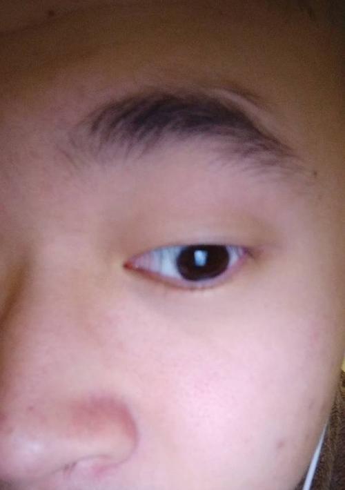 如何处理天生眼球突出问题（眼球突出的原因）