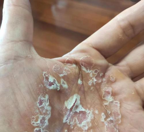 热水器使用后手痒是什么原因？如何解决？